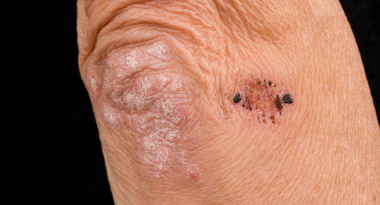Was könnte die Ursache für einen fleckigen Hautausschlag an Ellenbogen und Knien sein?