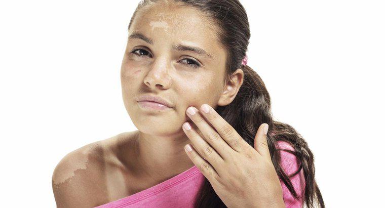 Ist es schlecht, sonnenverbrannte Haut zu schälen?