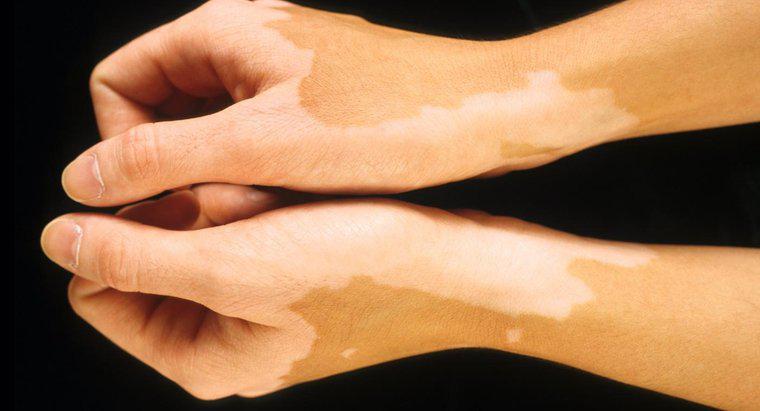 Was verursacht helle Flecken auf der Haut?