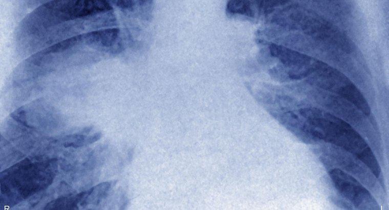 Was ist ein Lymphom der Lunge?