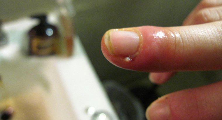Was muss eine Person mit einem geschwollenen Finger von einer Nagelhautinfektion tun?