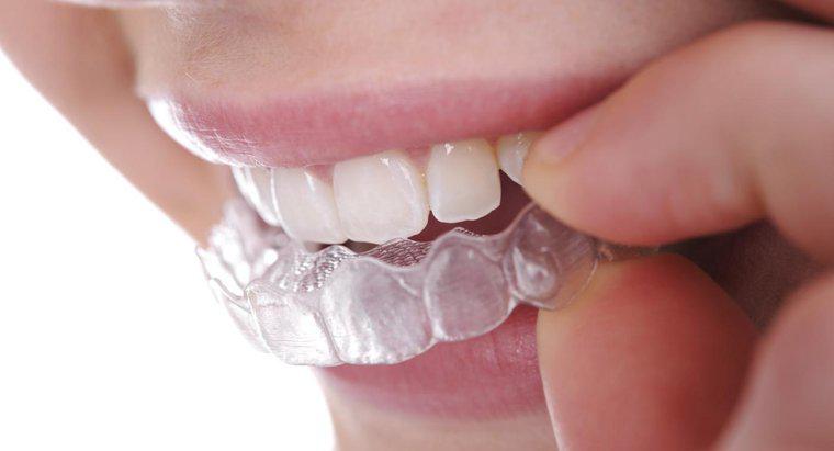 Wie begradigt man Zähne ohne Zahnspange?