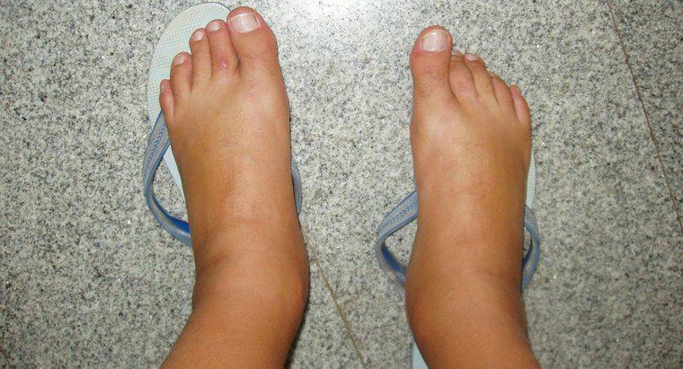 Was sind die Ursachen für geschwollene Füße?