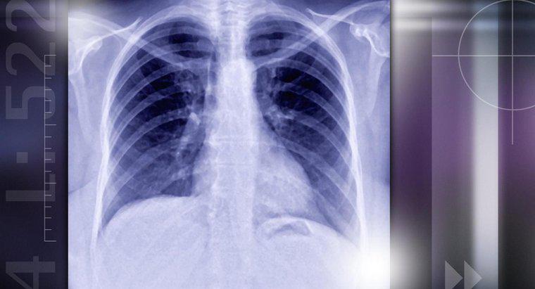 Was verursacht Lungenknoten?