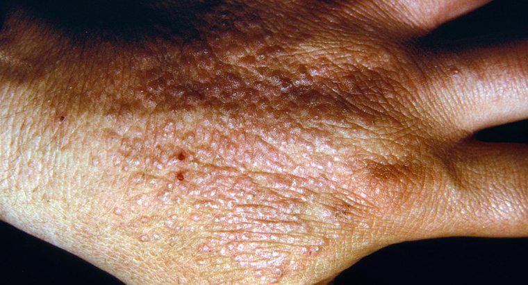 Wie treten Menschen mit Dermatitis in Kontakt?