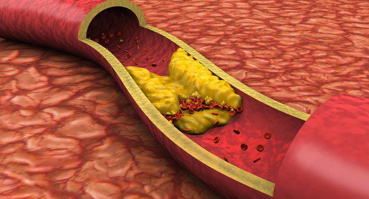 Was sind Symptome von verstopften Arterien?