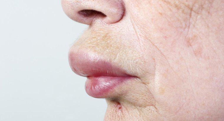 Wie heilen Sie eine geschwollene Lippe und ein geschwollenes Gesicht?