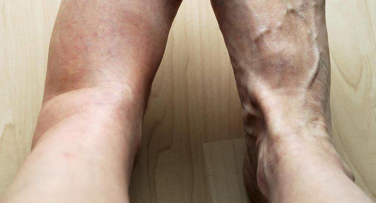Was sind einige mögliche Ursachen für Schmerzen und Schwellungen im linken Bein?