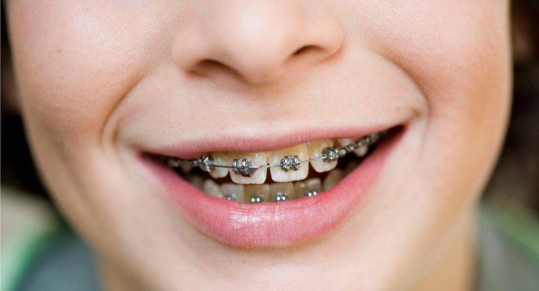 Wie wirken sich Zungenpiercings auf Zahnspangen aus?