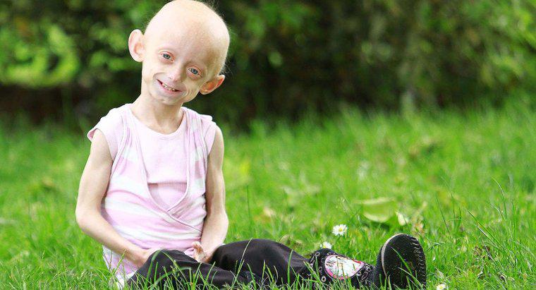 Was sind einige interessante Fakten über Progerie?