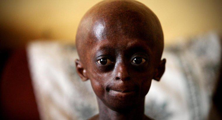 Welche Einschränkungen hat eine Person mit Progerie?