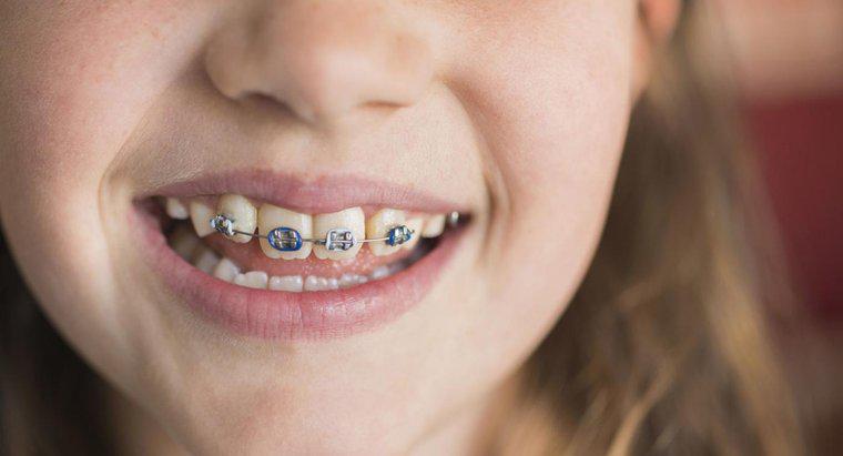 Was sind einige gute Witze über Zahnspangen?