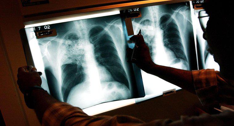 Was sind die langfristigen Auswirkungen von Tuberkulose?