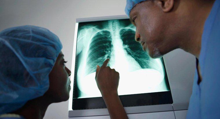 Welche Symptome sind einzigartig für Lungenkrebs?