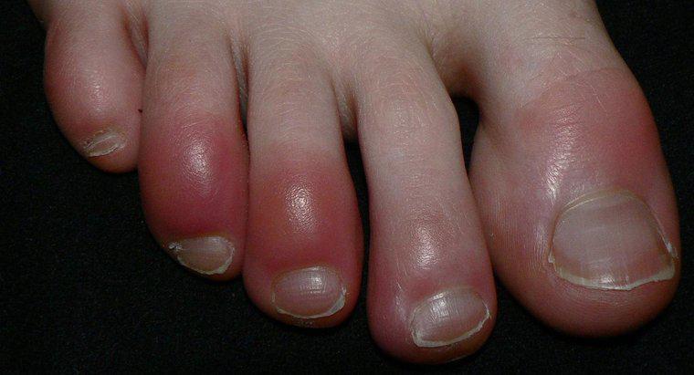Sind rote Zehen ein Symptom des Raynaud-Syndroms?