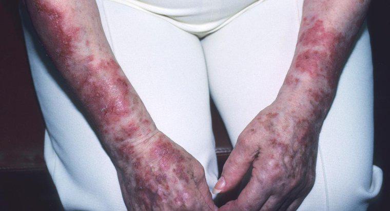 Wie wird Lupus verbreitet?