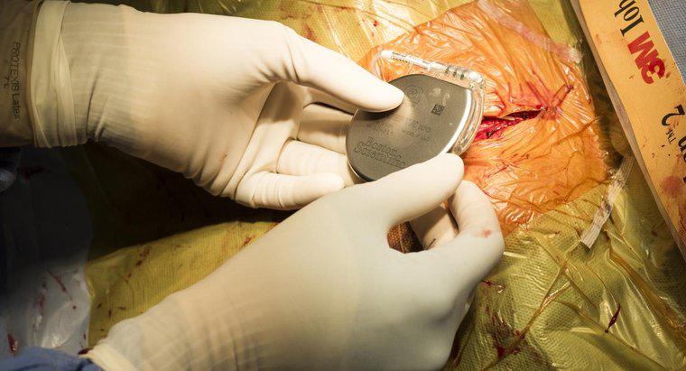 Wie sieht der Genesungsprozess für Patienten mit Herzschrittmacheroperation aus?