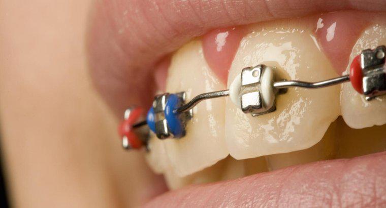 Was ist der Zweck der Gummibänder an Zahnspangen?