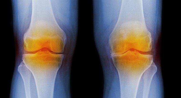 Was sind die Symptome von Arthritis im Knie?