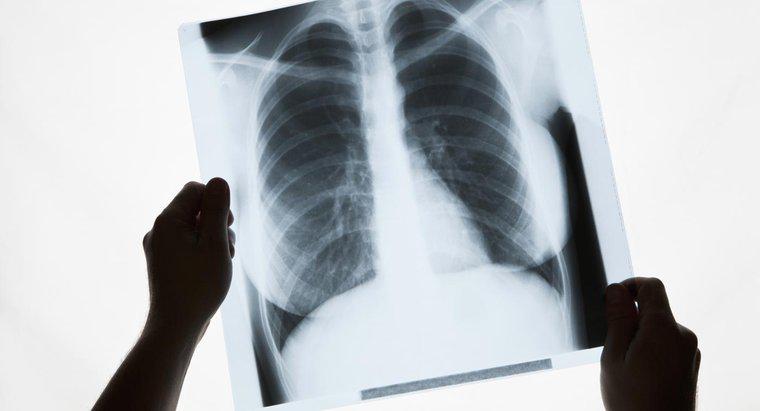 Was verursacht weiße Flecken in der Lunge?