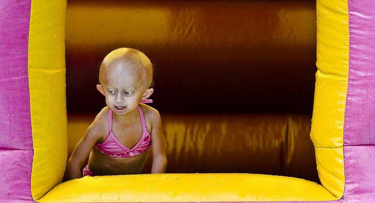 Wie lange können Sie mit Progerie leben?