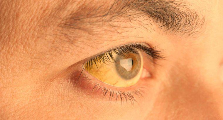 Was führt dazu, dass die Haut unter den Augen gelb wird?