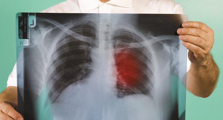 Was sind die ersten Anzeichen von Lungenkrebs?