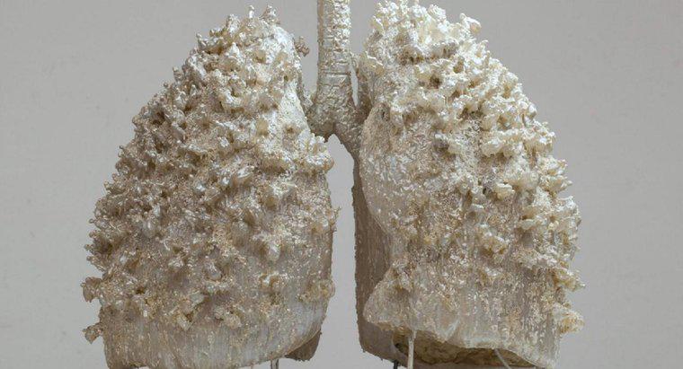 Kann eine Person mit einer Lunge leben?